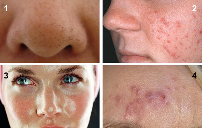 Аппарат аквапилинга ADSS Profacial