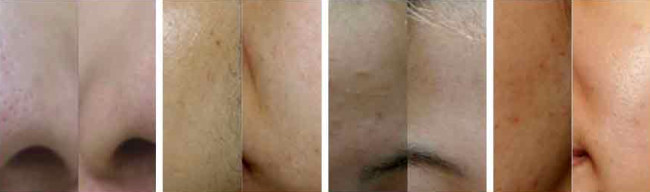 Аппарат аквапилинга ADSS Profacial