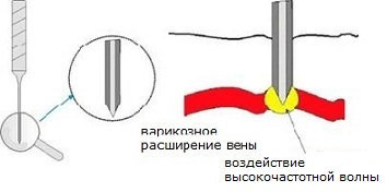 Аппарат для лечения сосудов ADSS VR2013